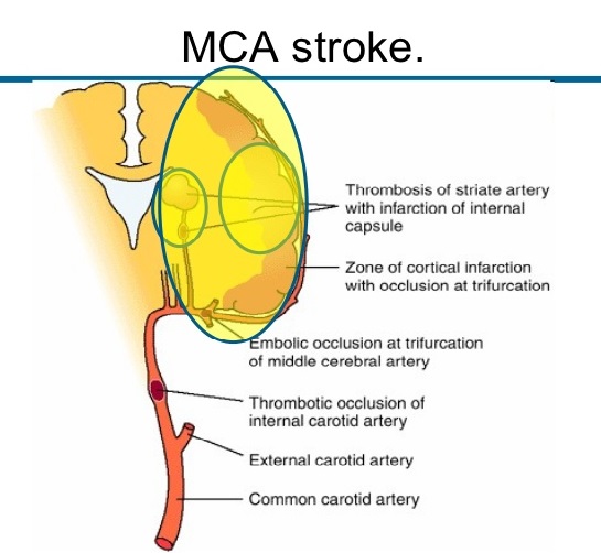 middle cerebral artery stroke case study